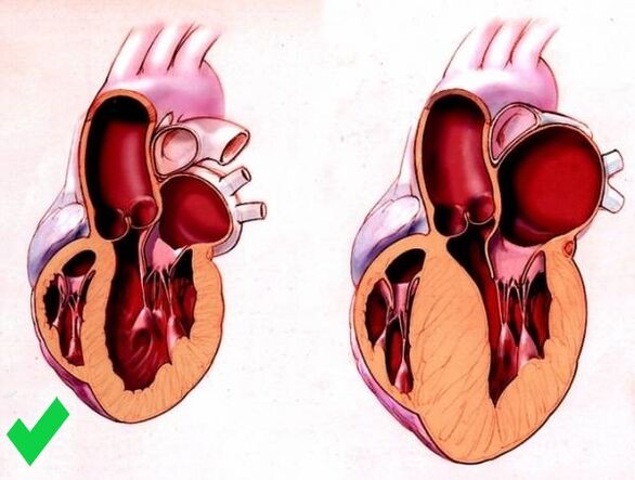 Cardione, kalbin ventriküler hipertrofisini önler